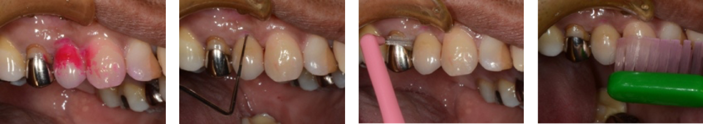 インプラントを長持ちさせるには