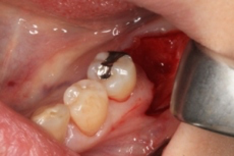 骨を造る?特殊なインプラントを紹介