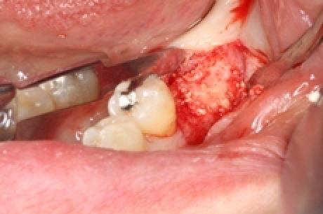骨を造る?特殊なインプラントを紹介