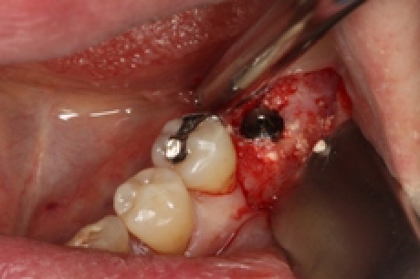 骨を造る?特殊なインプラントを紹介