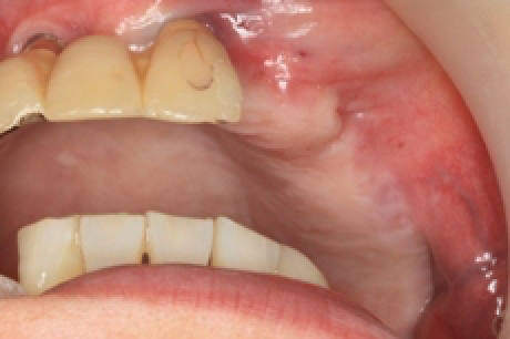 骨を造る?特殊なインプラントを紹介