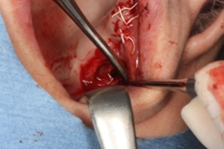 骨を造る?特殊なインプラントを紹介