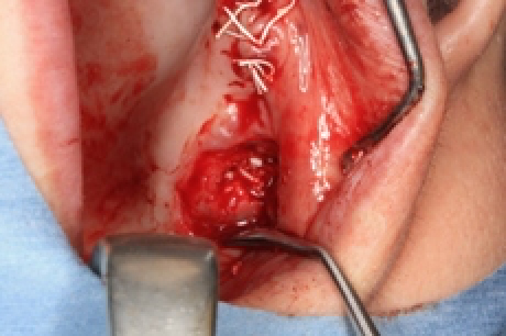 骨を造る?特殊なインプラントを紹介