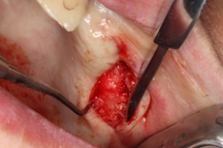 骨を造る?特殊なインプラントを紹介