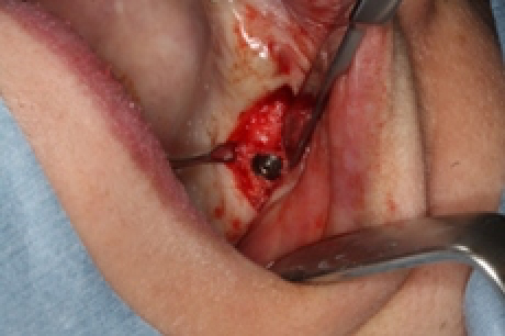 骨を造る?特殊なインプラントを紹介