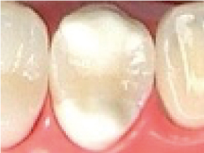 ハイブリッドセラミックス