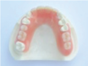 ノンクラスプ義歯