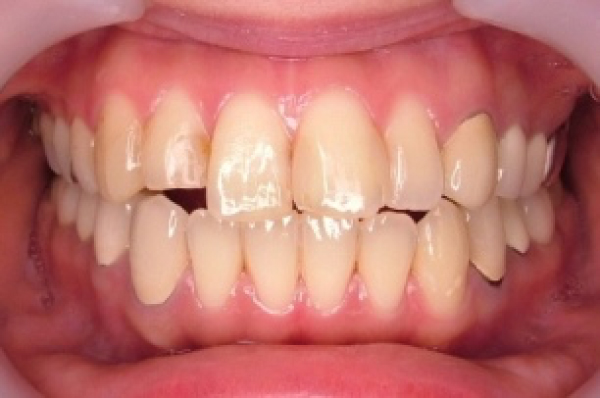 セラミックス治療