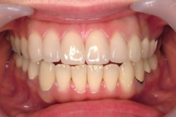 セラミックス治療