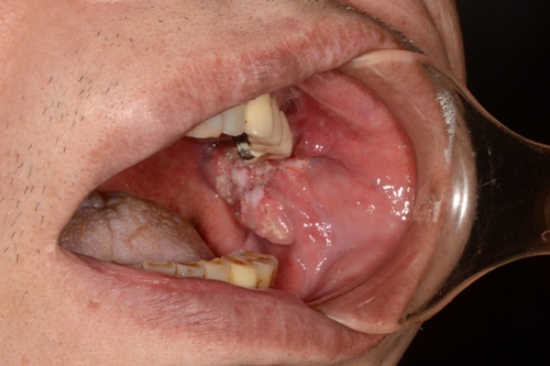 口腔がんについて